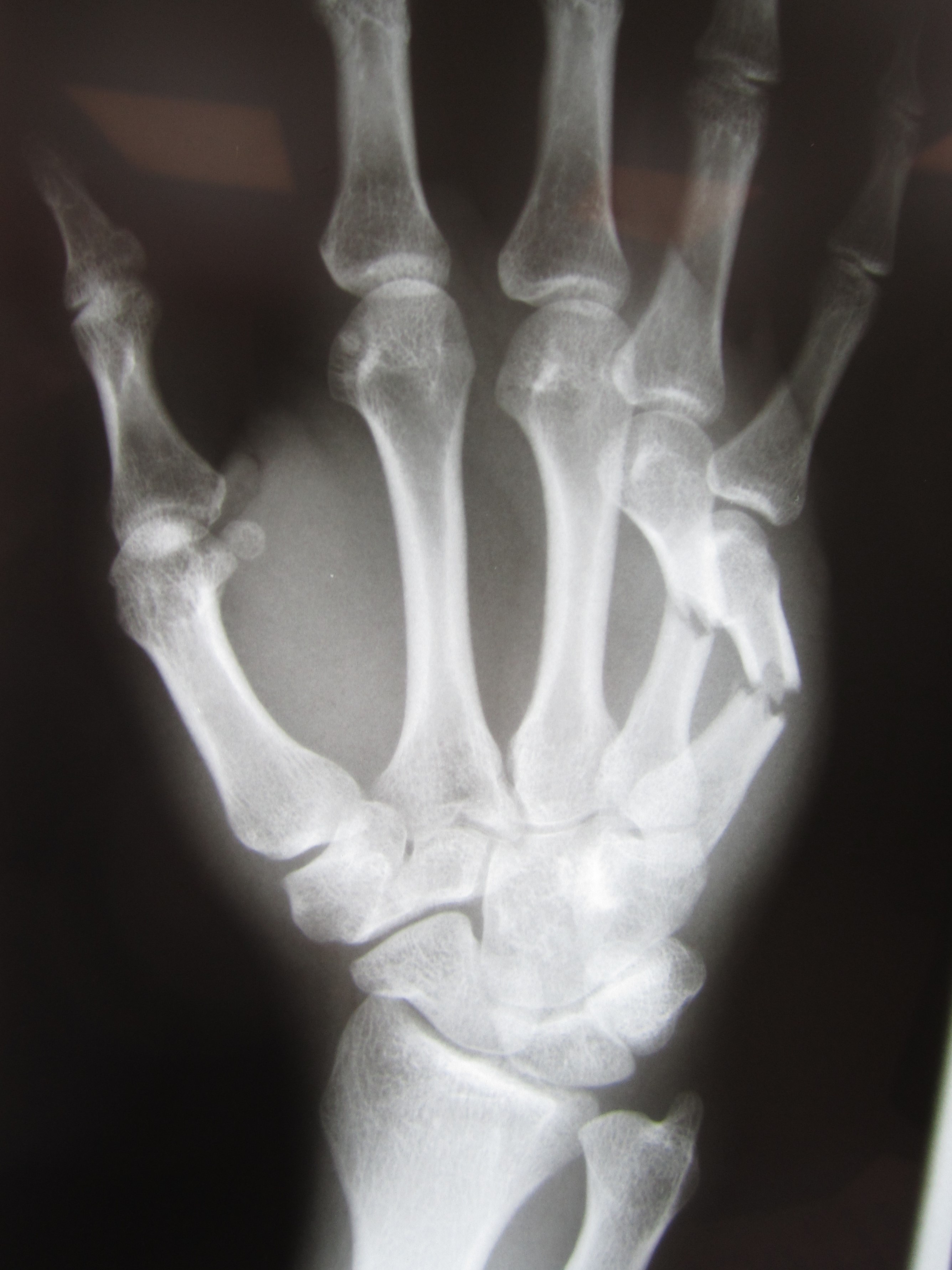 metacarpal fracture