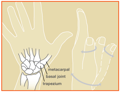 Basilar Thumb (CMC) Arthritis