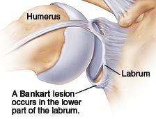 shoulder instability