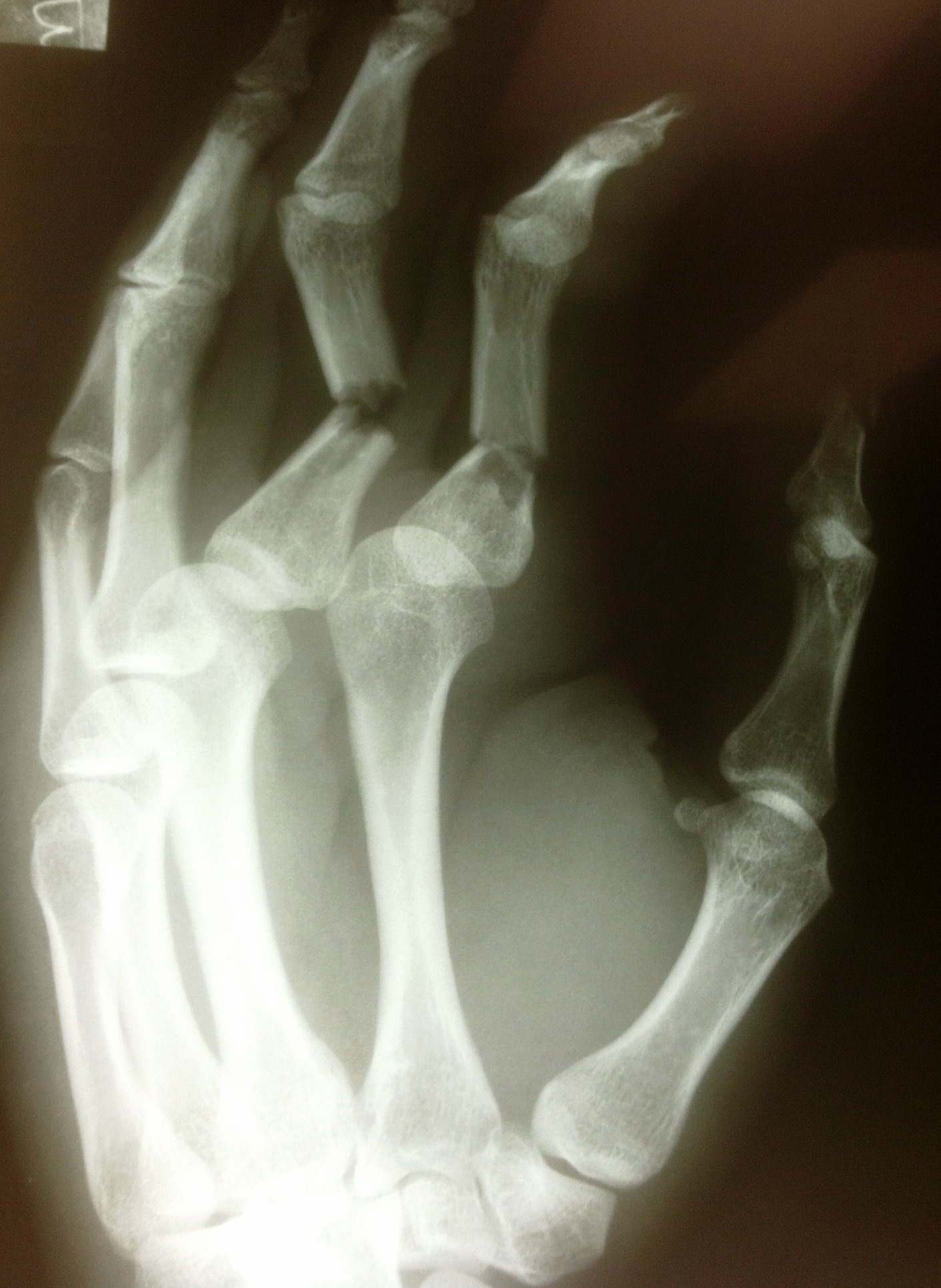 broken fingers