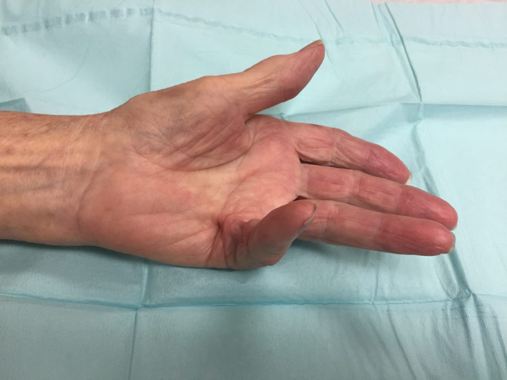 Dupuytrens contracture