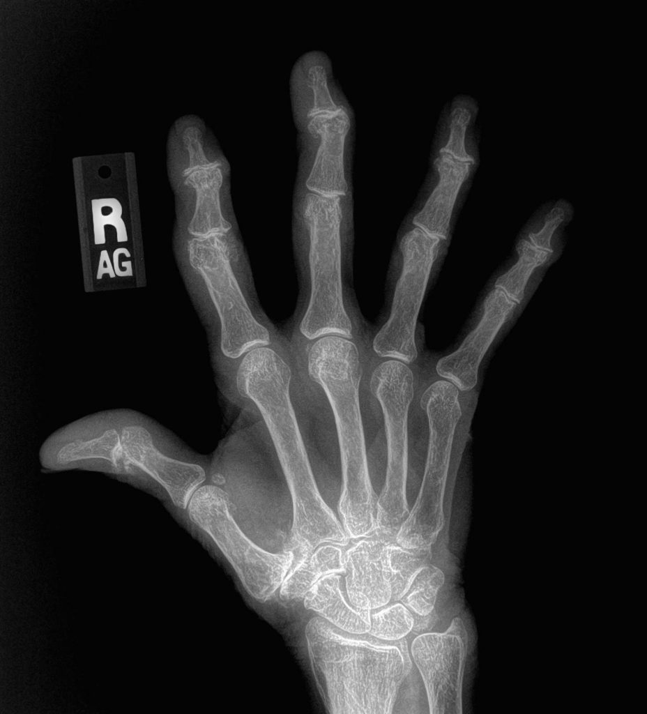 severe hand osteoarthritis x-ray