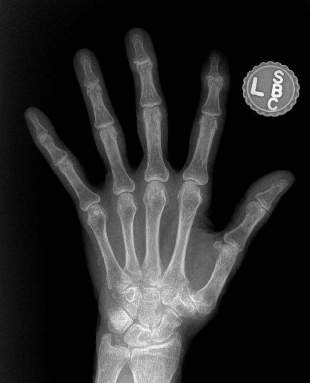 moderate hand osteoarthritis x-ray