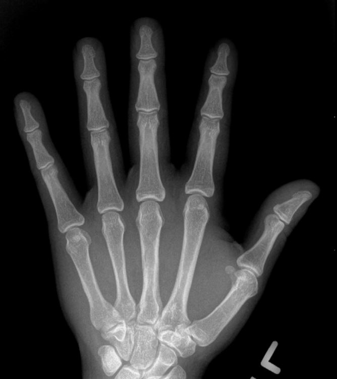 normal hand xray