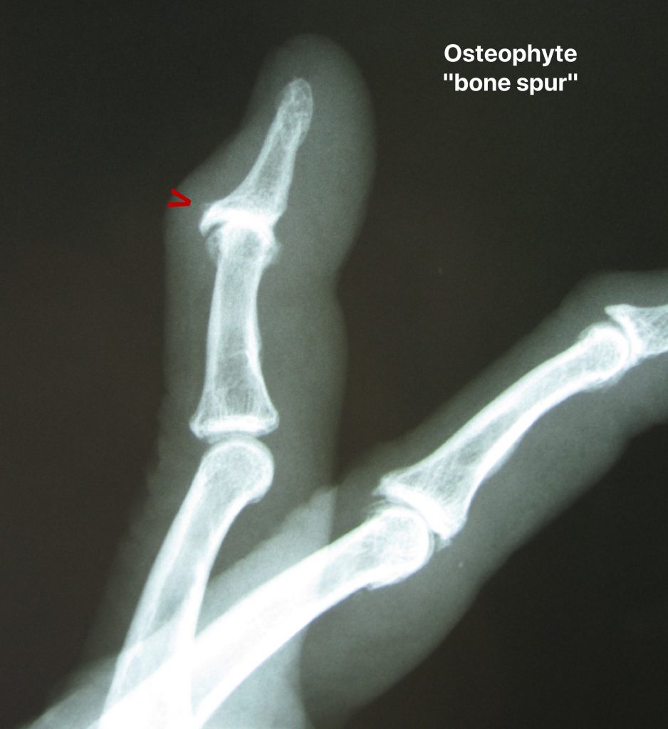 hand arthritis on x-rays