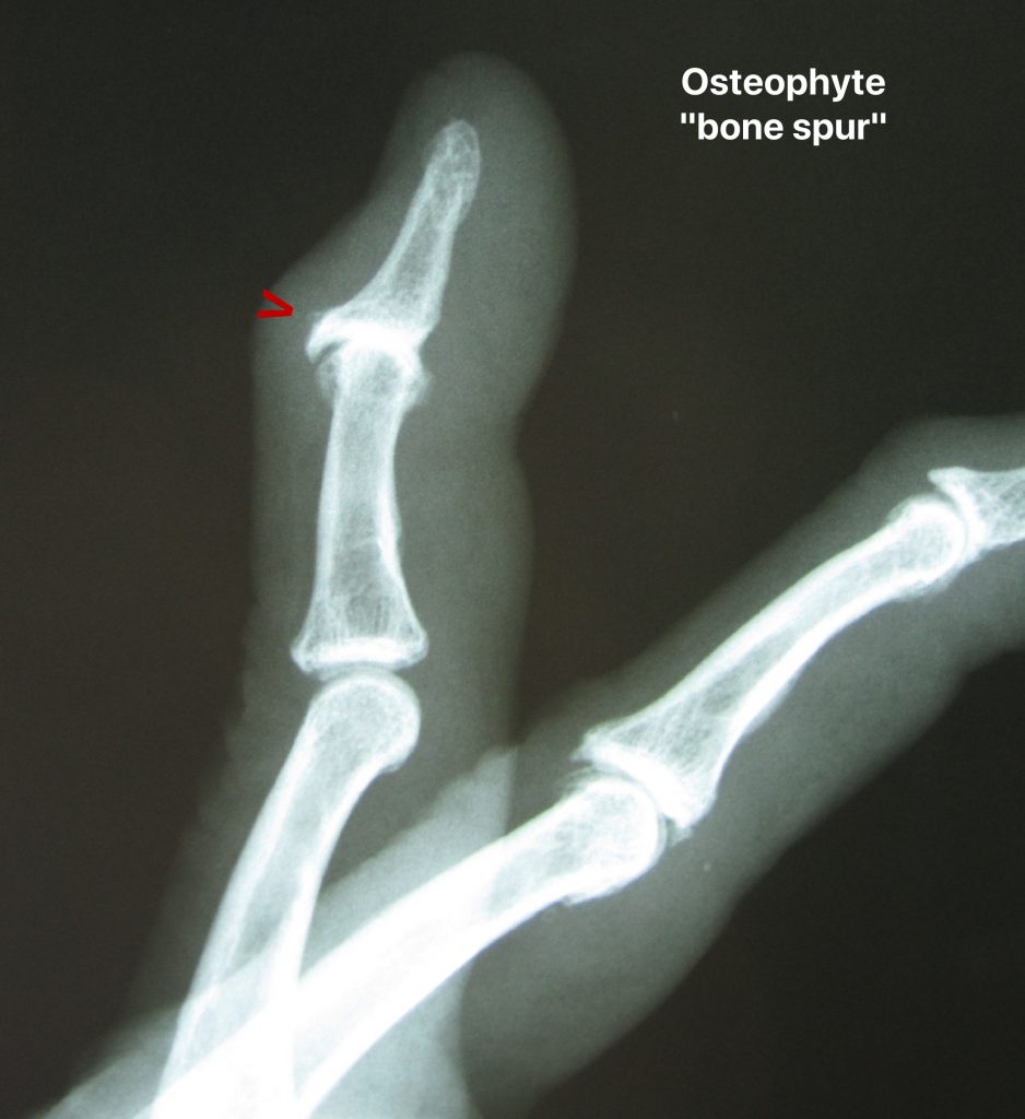 calcaneal spur xray