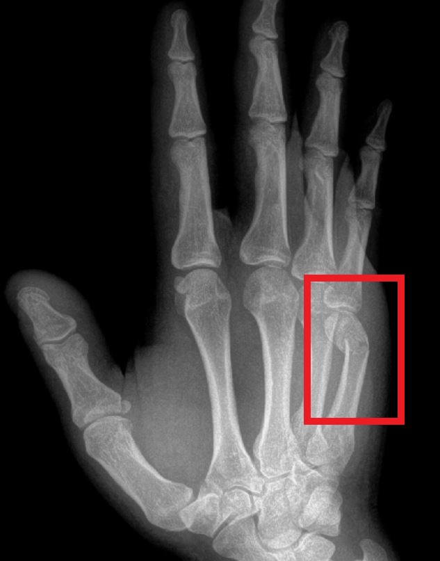 boxers fracture