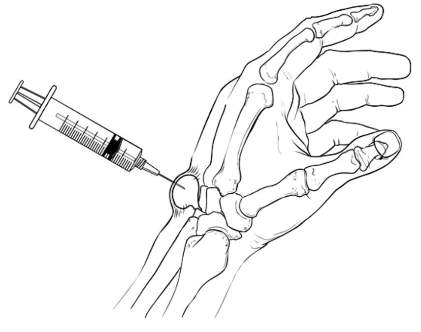 aspiration of ganglion cyst