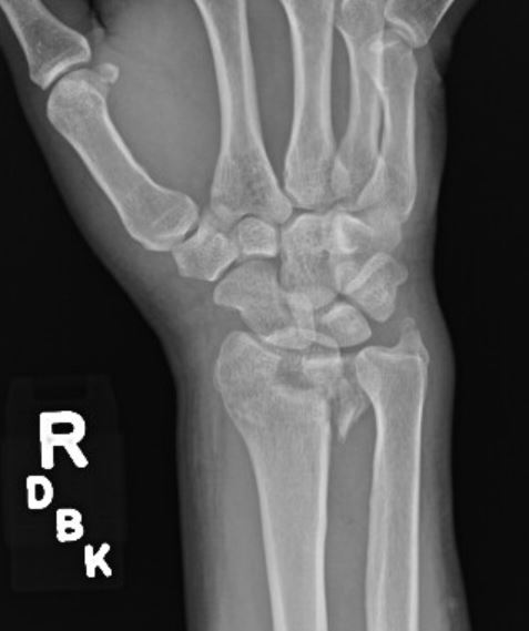 distal radius fracture