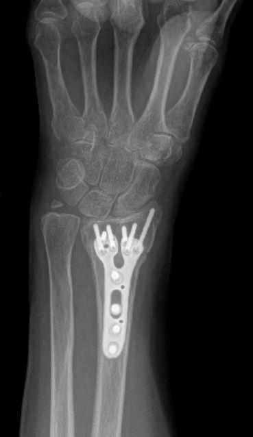 broken wrist treatment ORIF