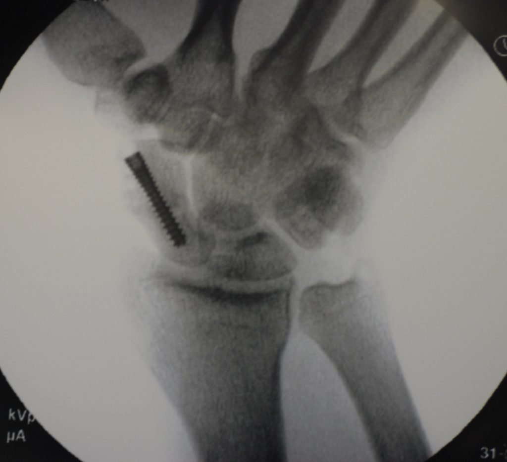 scaphoid fracture surgery