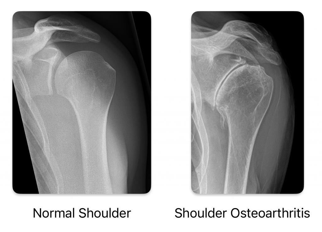 shoulder arthritis