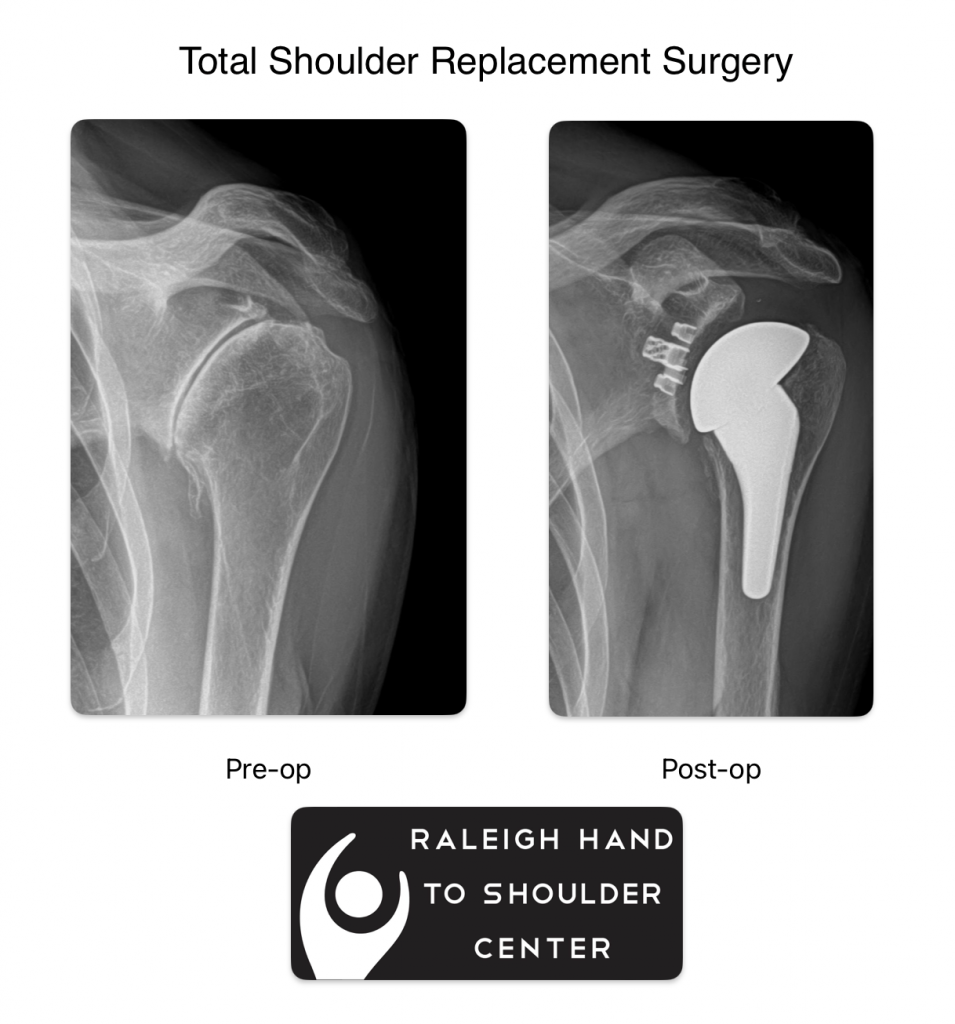 shoulder replacement surgery