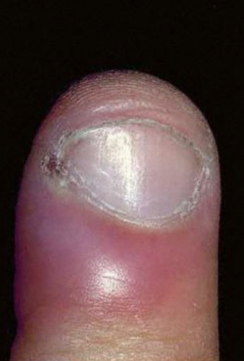 Fungal infection in the nails - top 10 natural remedies | TheHealthSite.com