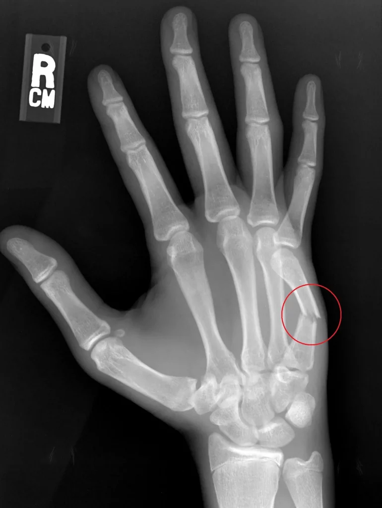 metacarpal fracture