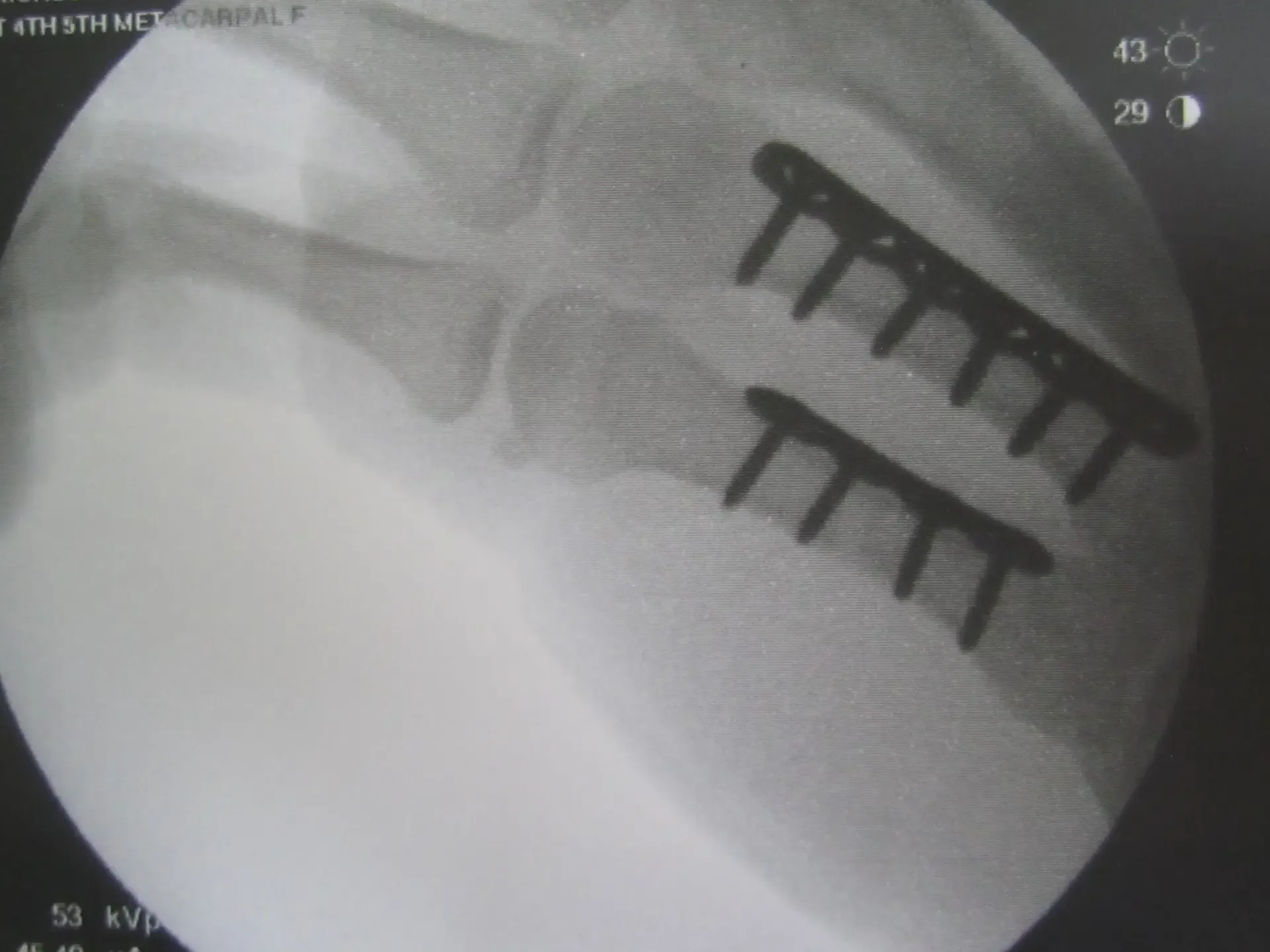4th and 5th metacarpals