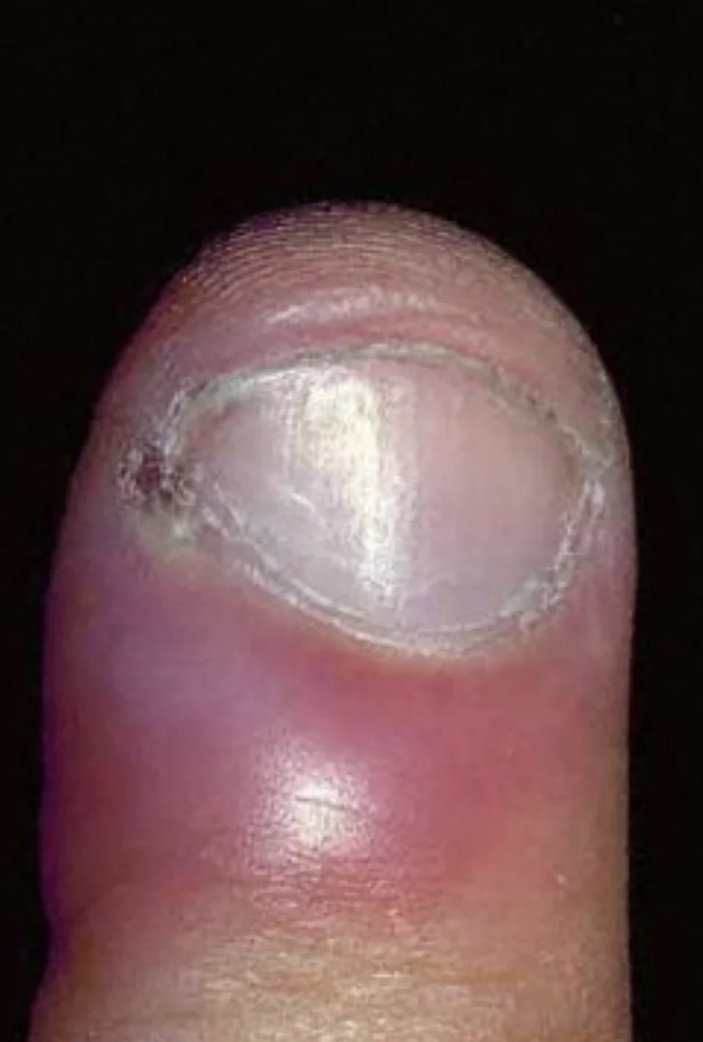 Paronychia Fingernail infection