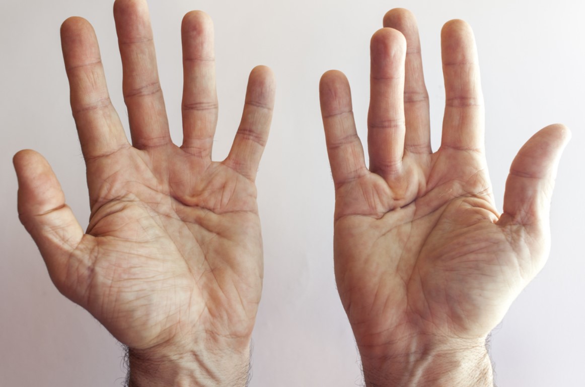 Dupuytren Contracture: Causes, Symptoms & Treatment