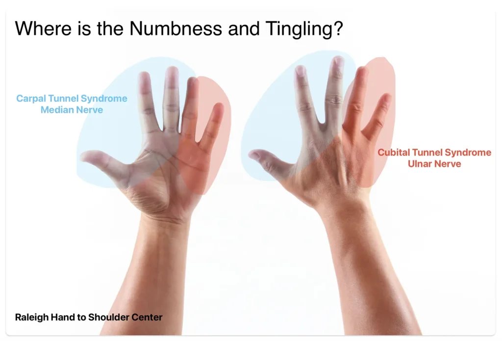 Carpal Tunnel vs Cubital Tunnel