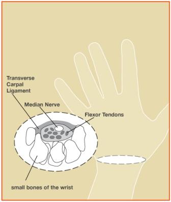 carpa; tunnel syndrome