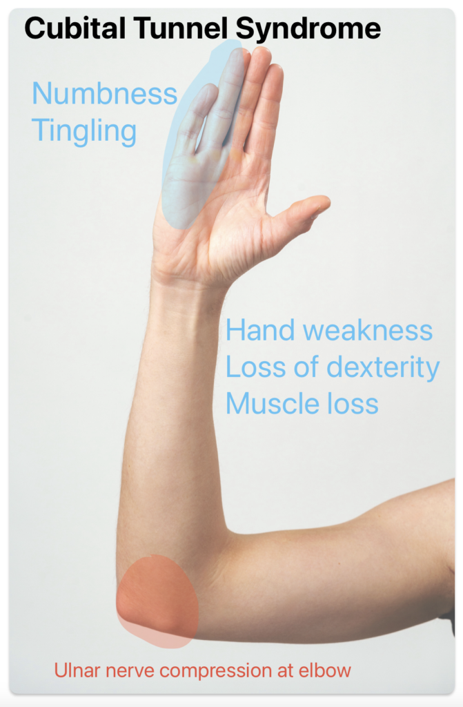 ulnar nerve in elbow and hand
