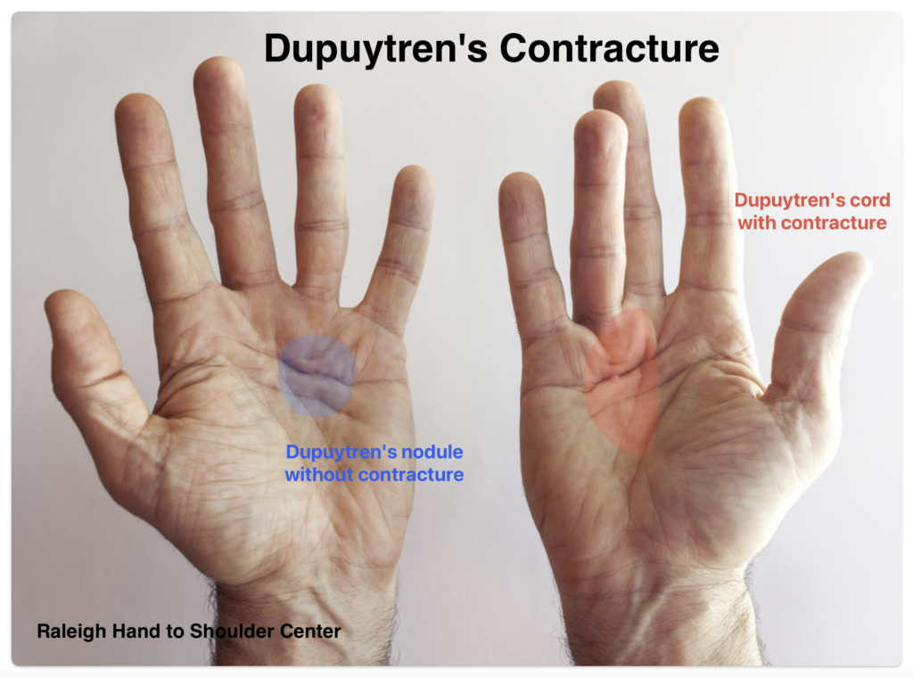 Dupuytrens Contracture in hands