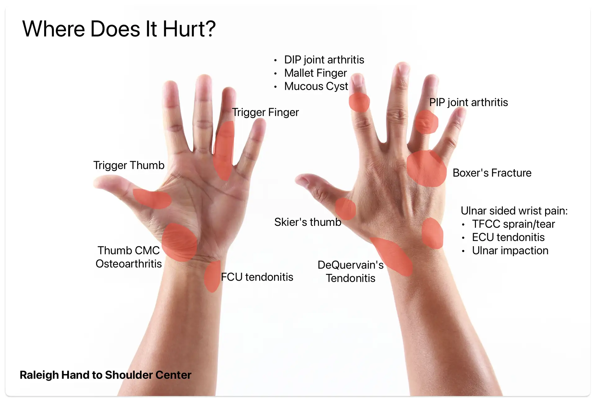 Hand Pain Locations