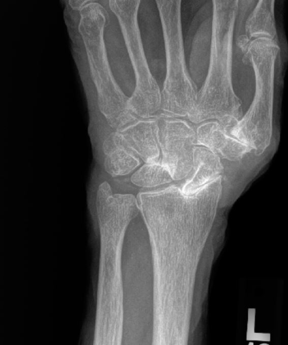 Wrist Arthritis Xray