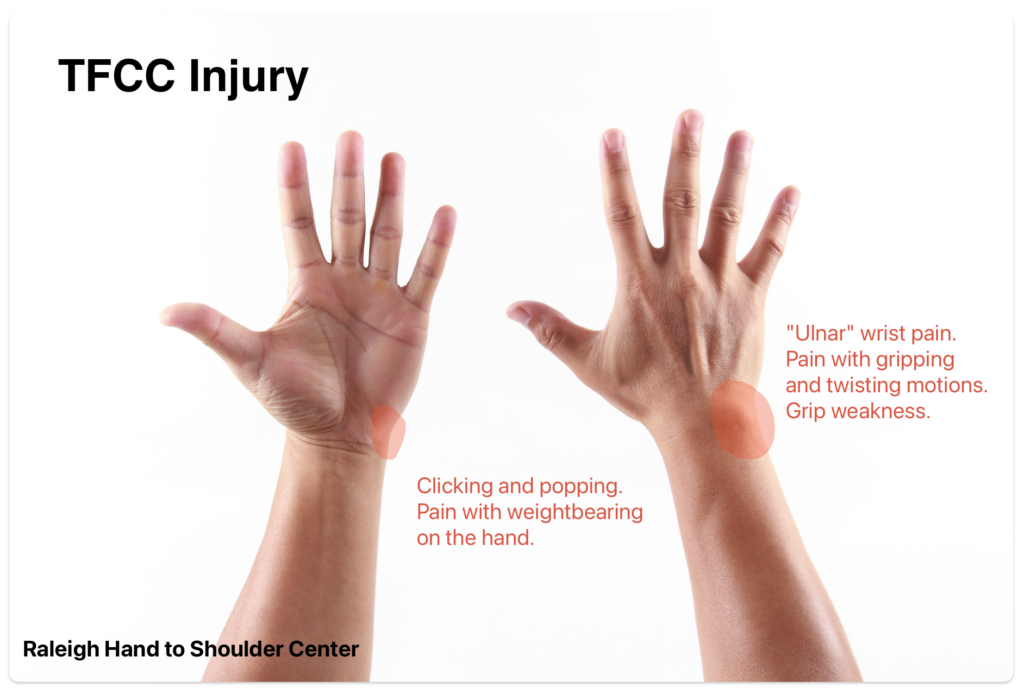 TFCC tear location at base of small finger in the wrist