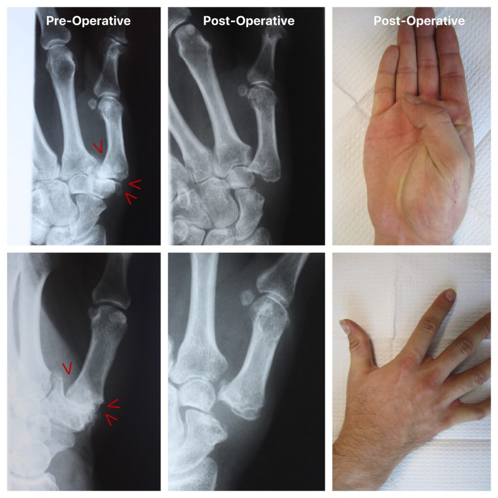 Thumb CMC Joint Arthritis, Before and After Surgery