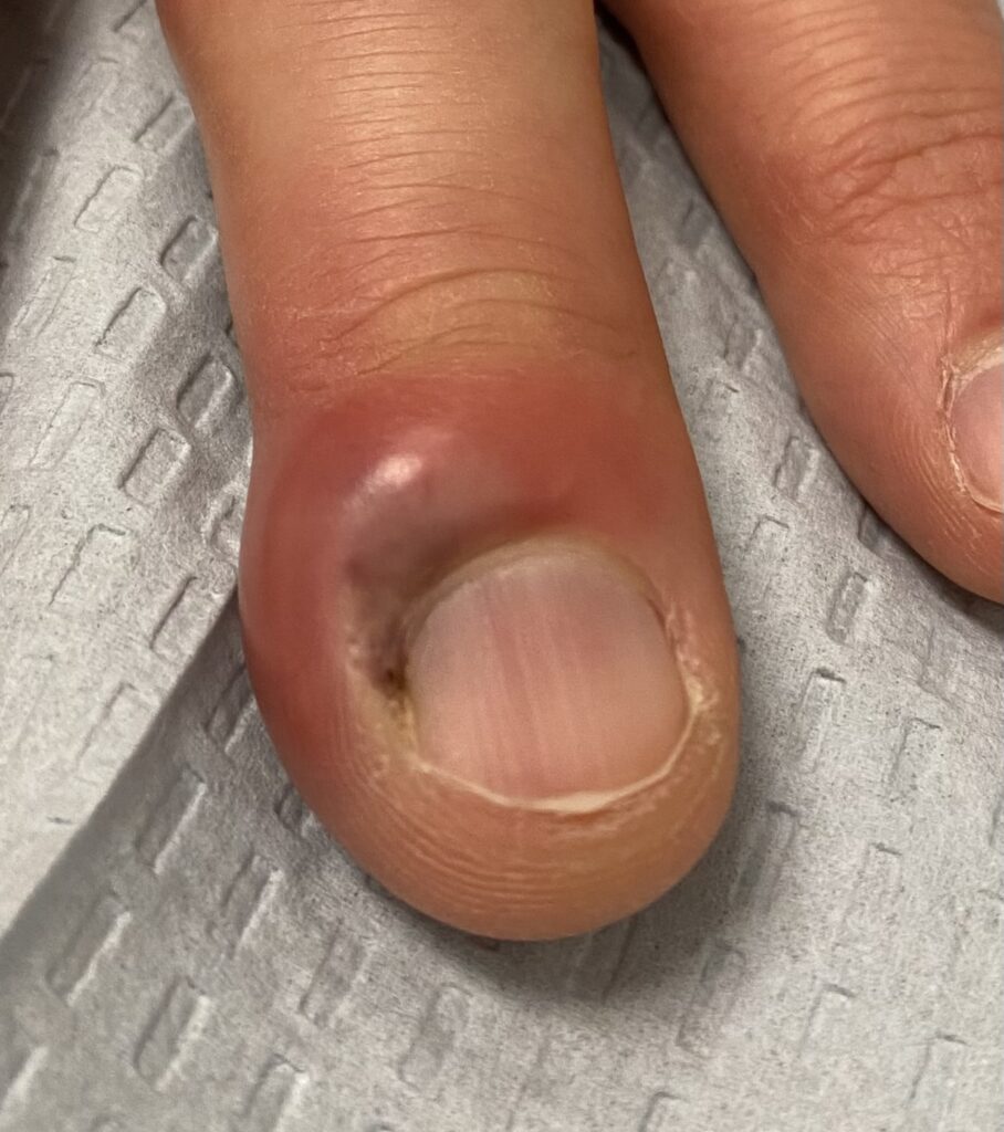 paronychia infection