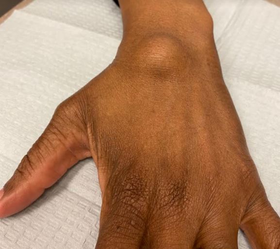 ganglion cyst in wrist