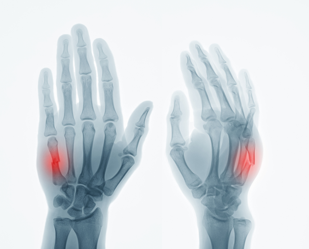 metacarpal fracture