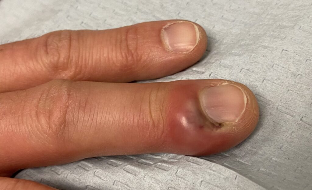 paronychia fingernail infection