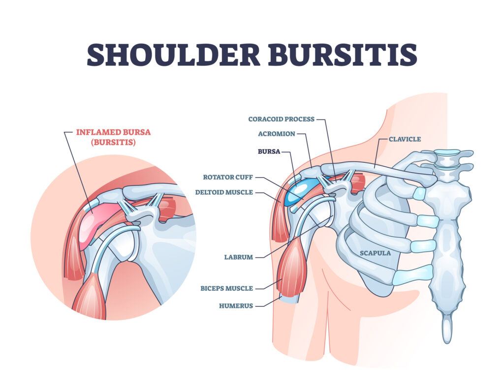shoulder bursitis from inflamed bursa in the shoulder